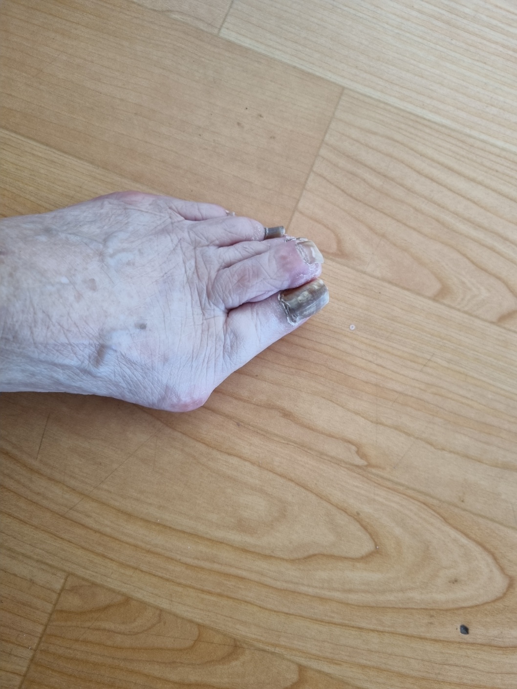 발톱무좀(조갑진균증) 두꺼워진 발톱 어떻게 하면 얇아 질수 있을까?