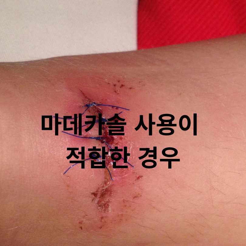 후시딘과 마데카솔 차이점 총정리!