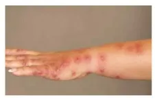 빈대 퇴치제 빈대 물린 자국