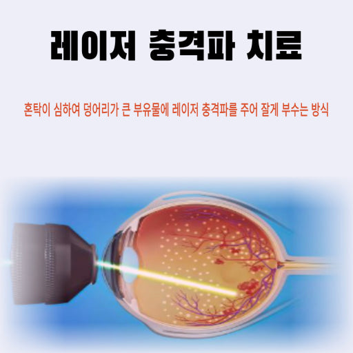 비문증 증상과 원인, 치료방법