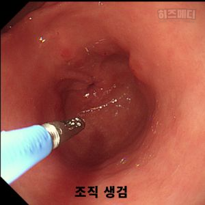 위축성 위염 진단 치료