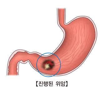 위암 3기 생존율