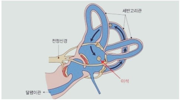 이석증 원인