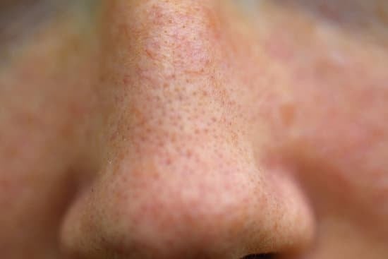 골드 PTT(Gold PTT) 여드름 모공 개선을 위한 차세대 피부 치료