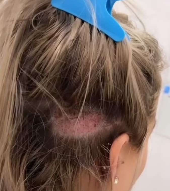 자신의 머리 털로 눈썹 이식한 10대...어머! 숯덩이네! VIDEO:Cotswolds woman undergoes eyebrow transplant using hairs from head