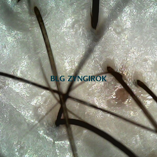 탈모 극복 프로젝트 - 정수리와 이마 사이 두피 모습이다.