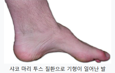 샤코 마리 투스 질환
