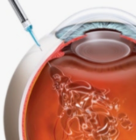 황반변성 자가진단&#44; 치료법&#44; 주사치료 가격