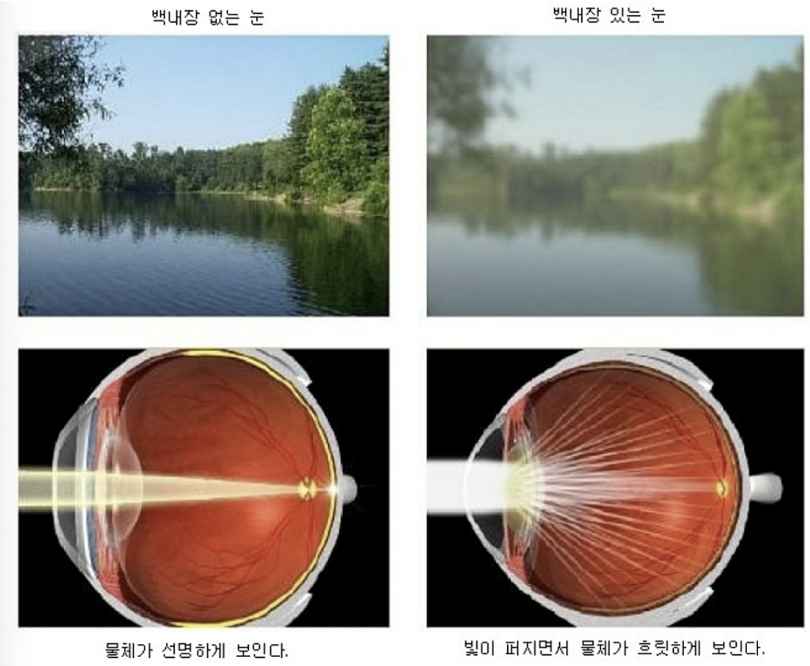 백내장 녹내장 차이