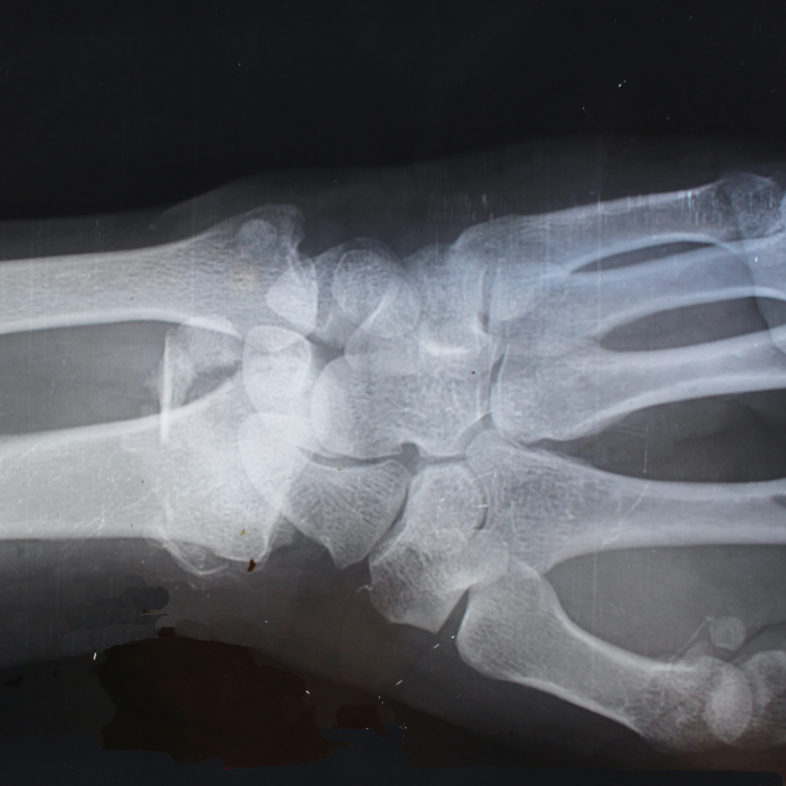 DEXA