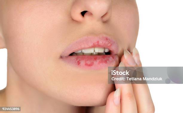 구순염 관련 사진