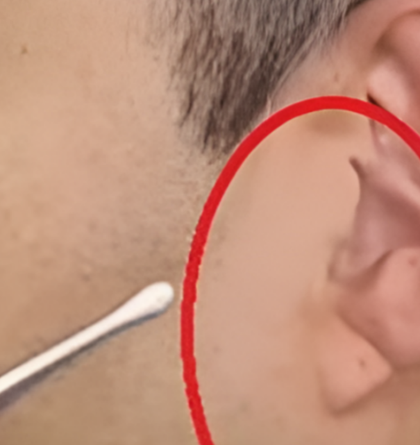 프랭크증후군-사진7