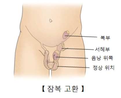 남아 견축고환, 활주고환, 잠복고환