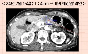 췌장암 초기 증상 췌장암 등통증 위치 검사_10