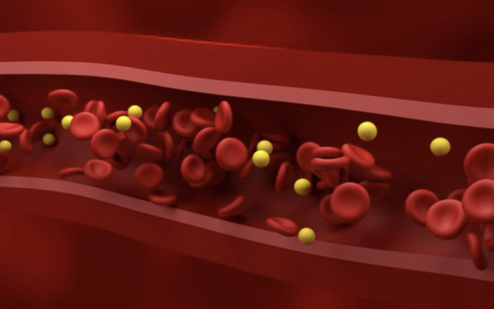 중성지방이 쌓인 혈관