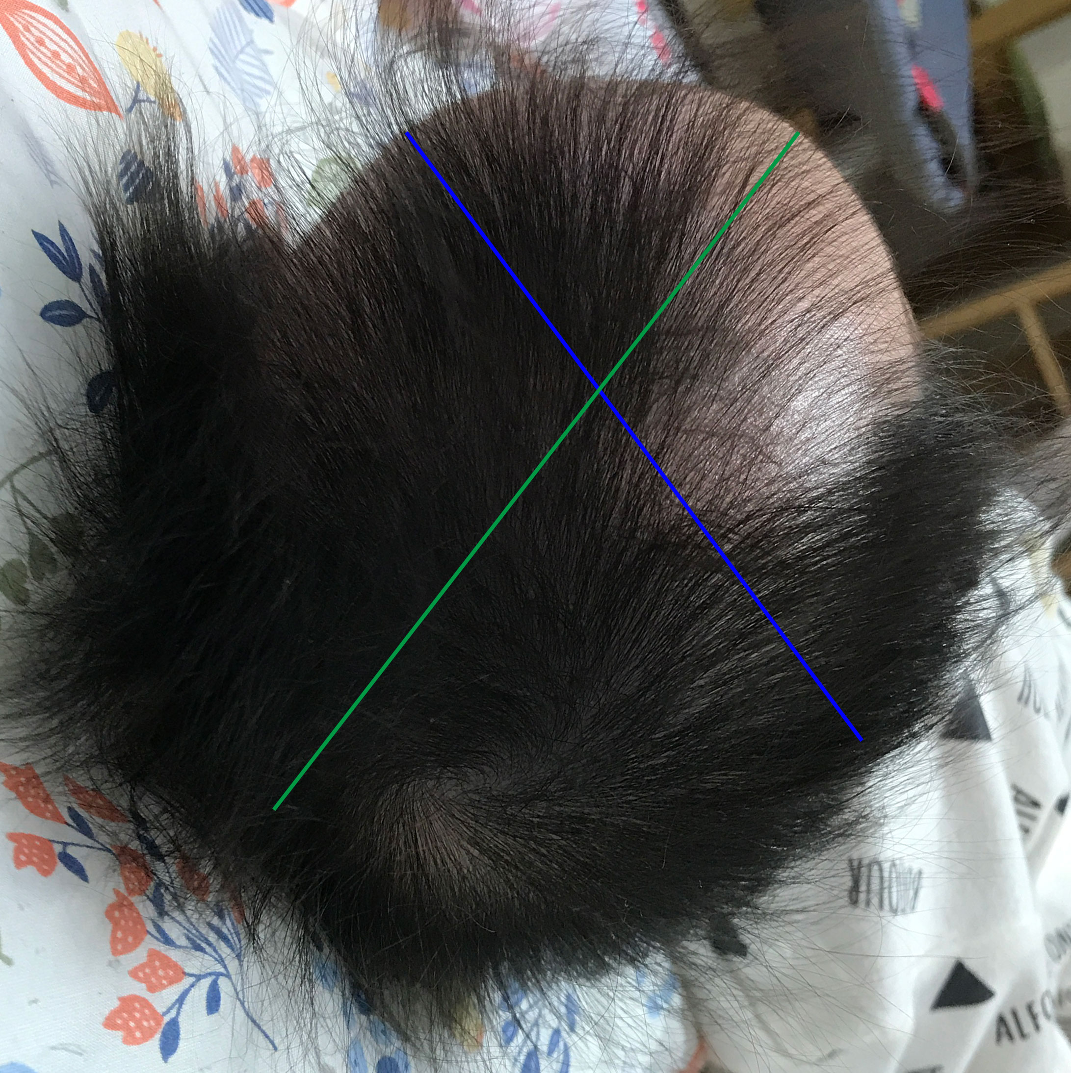 신생아 사두증 - 사두 수치 재는 방법