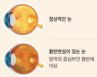 "안경값 아끼세요!" 2026년 어르신 안경 보조금 신청 방법과 자격