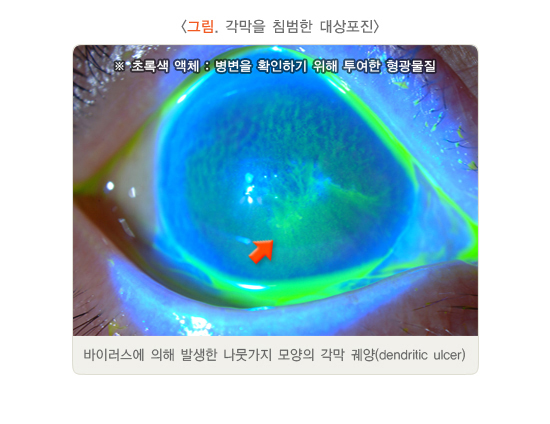 대상 포진 초기