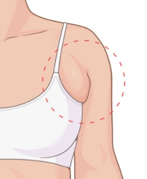 겨드랑이살 튀어나온 부유방 이미지