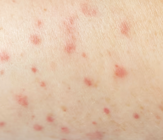 대상포진 초기증상 19