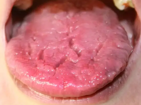 혓바닥 갈라짐 증상