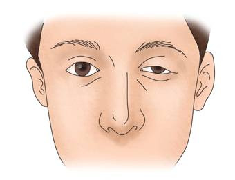 안검하수 증상부터 원인, 치료까지 -눈꺼풀 처짐