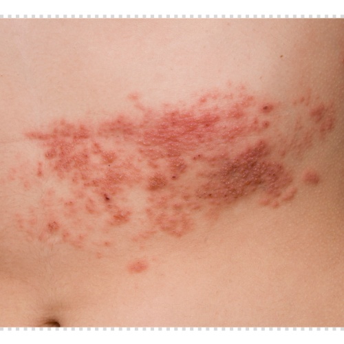 귀 대상포진 증상 후유증