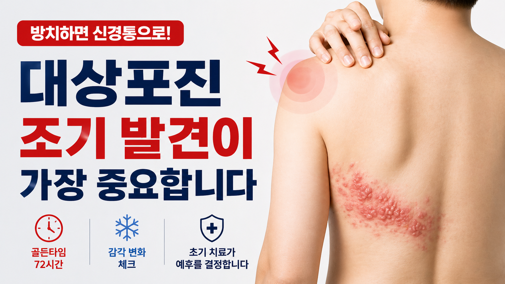 대상포진 (초기증상, 자가진단, 신경통)