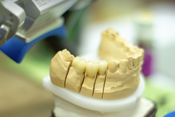 이갈이 원인과 턱 건강 마우스피스