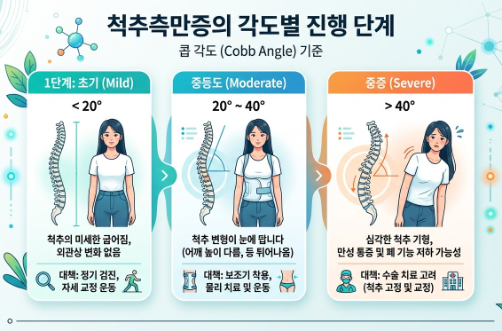 척추측만증 각도별 진행 단계를 보여주는 인포그래픽