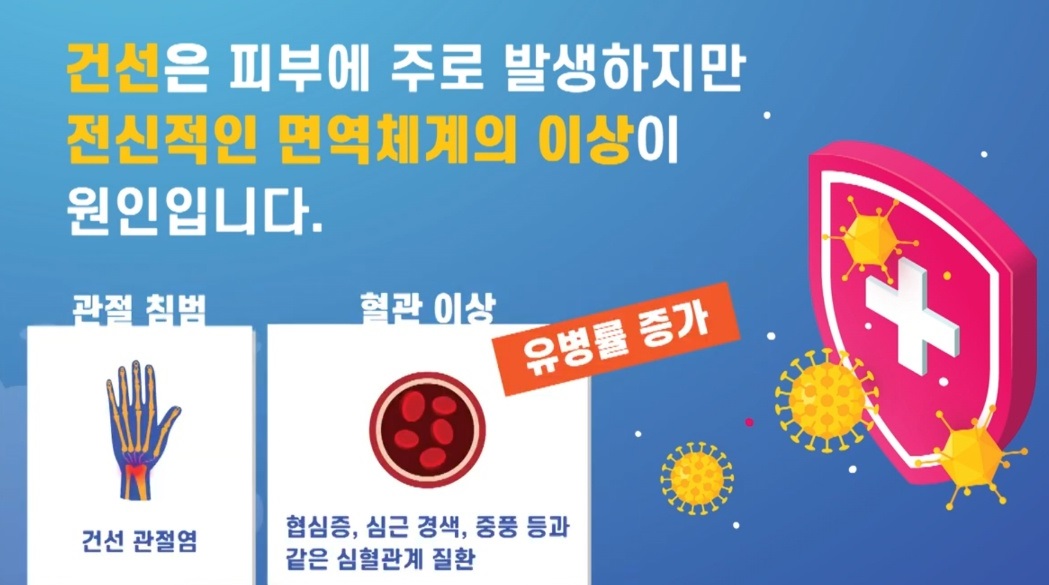 EBS명의-피부-명의-최용범-교수-건선