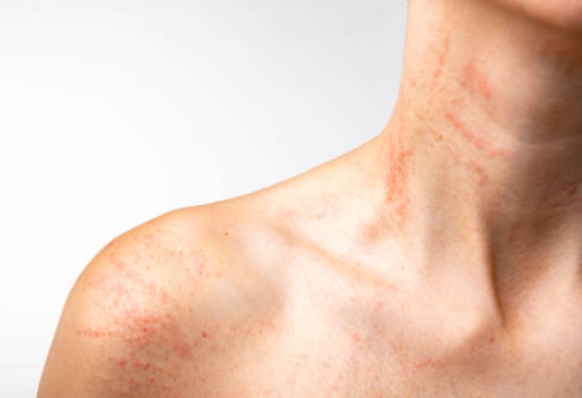전신에 나타난 자잘한 두드러기