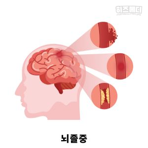 고혈압 증상 원인