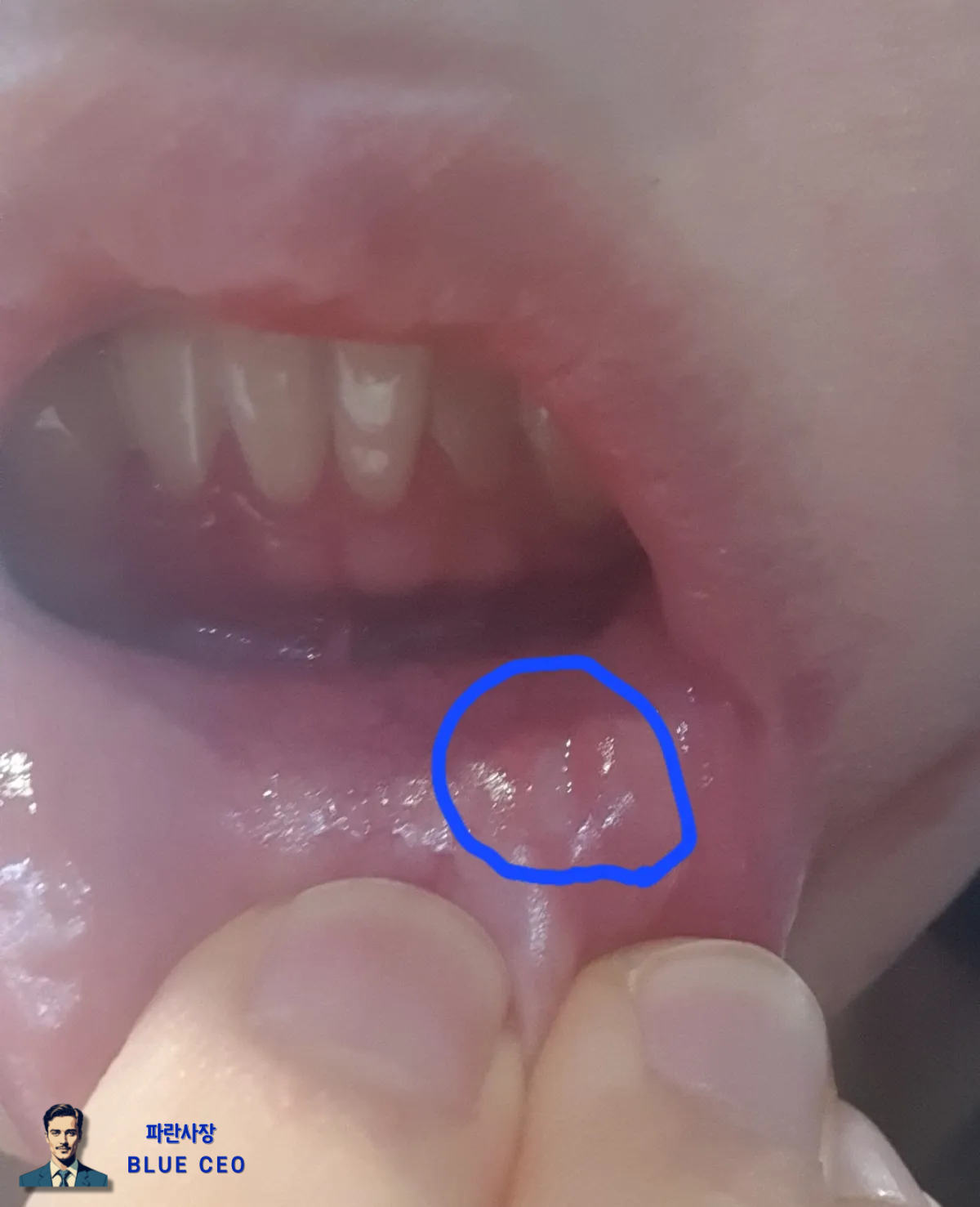 구내염-치료-연고-페리덱스-사용-후기-효과까지