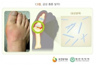 통풍 증상 치료법 초기증상 원인