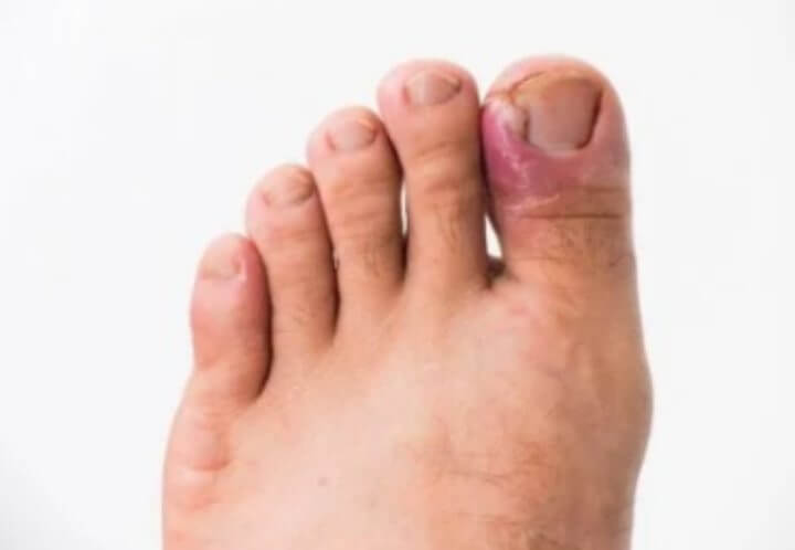 내성발톱 자가치료 교정기