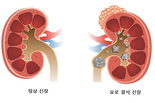 정상 신장 VS 요로 결석 신장