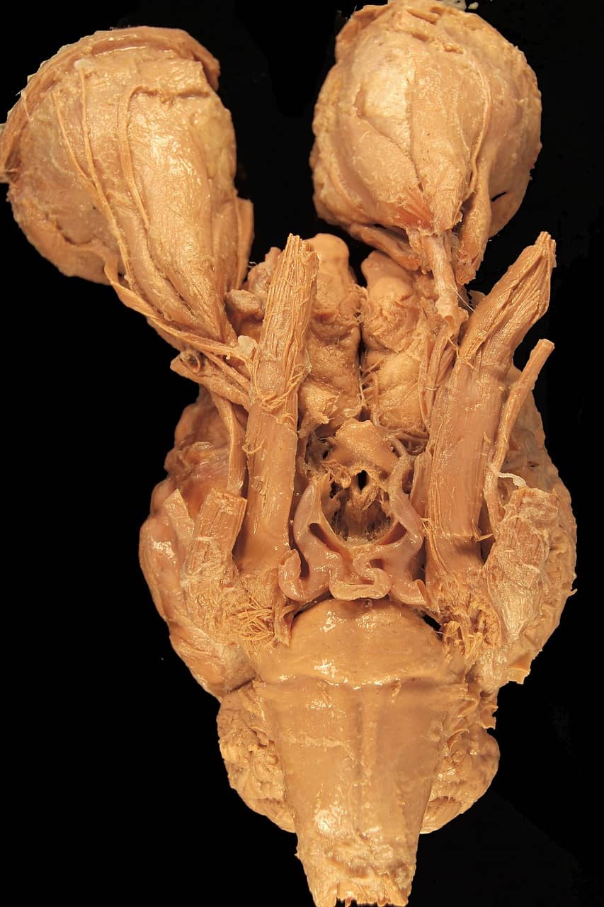 외측두엽 뇌전증, 언어와 청각 변화