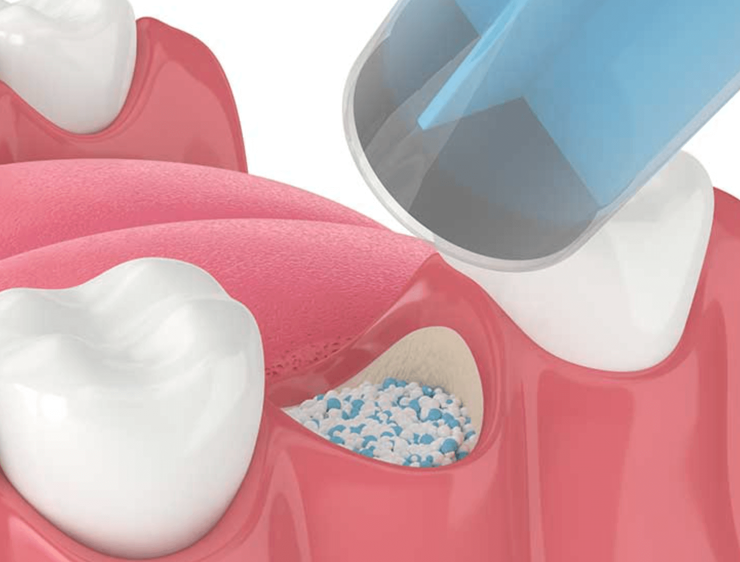 임플란트 뼈이식 비용