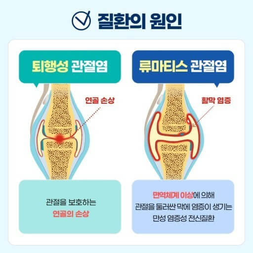류마티스 관절염