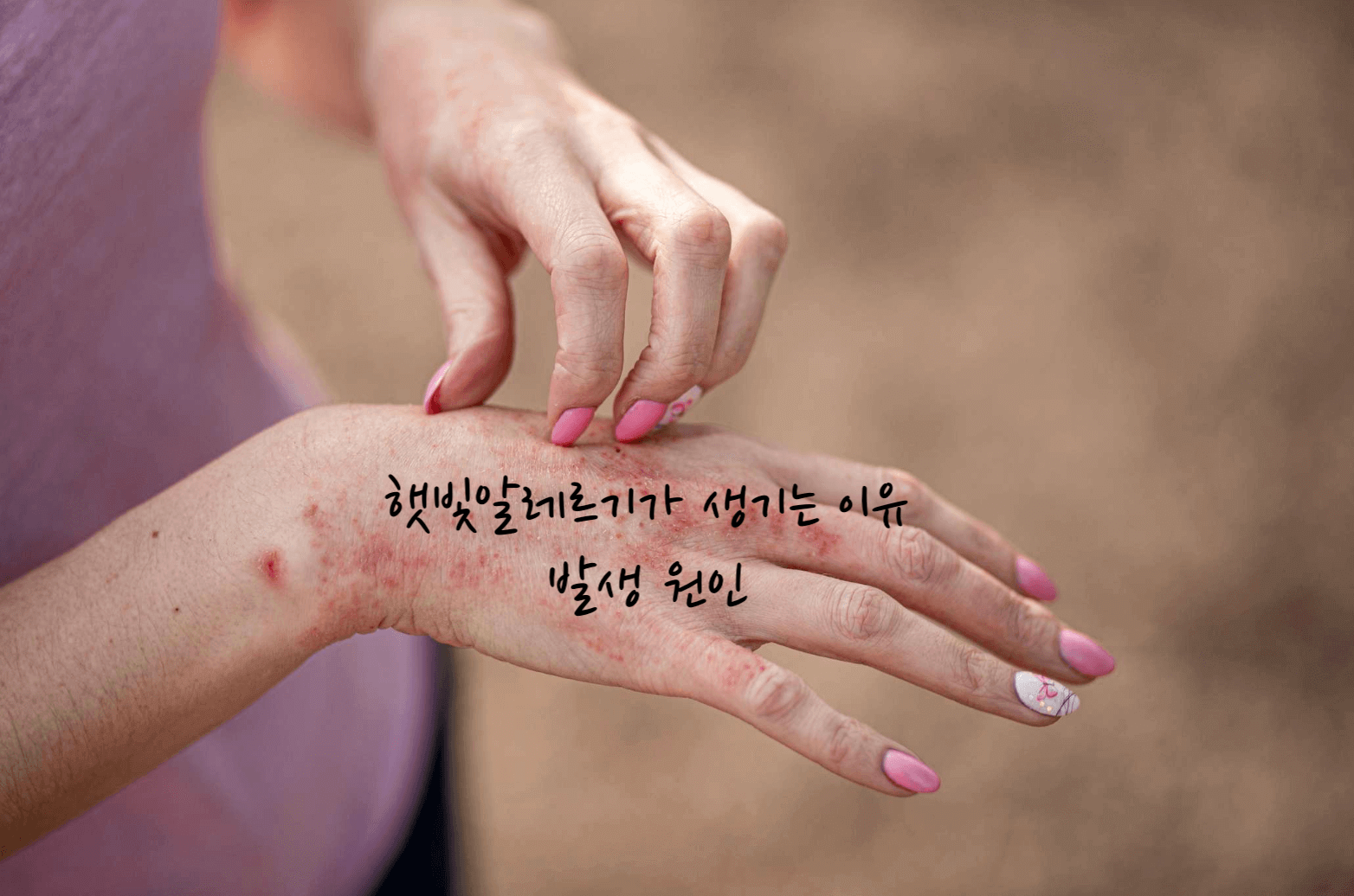 햇빛알레르기