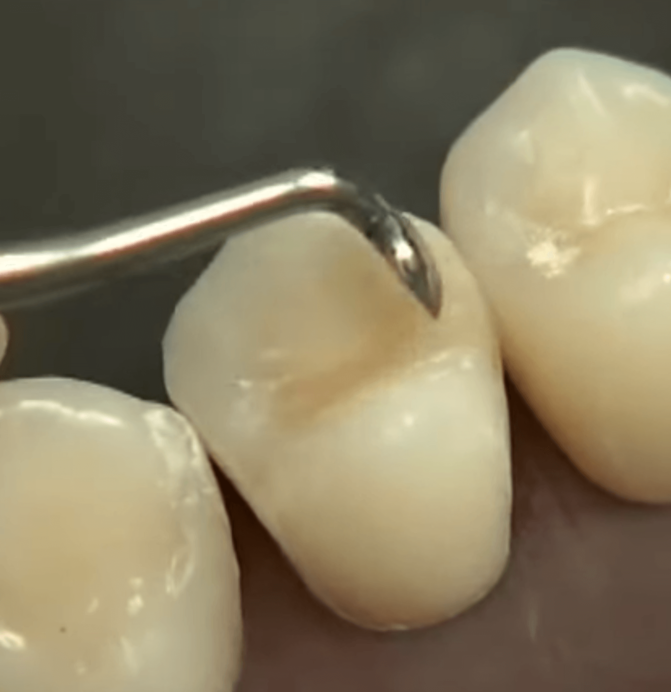 치아 치료 과정