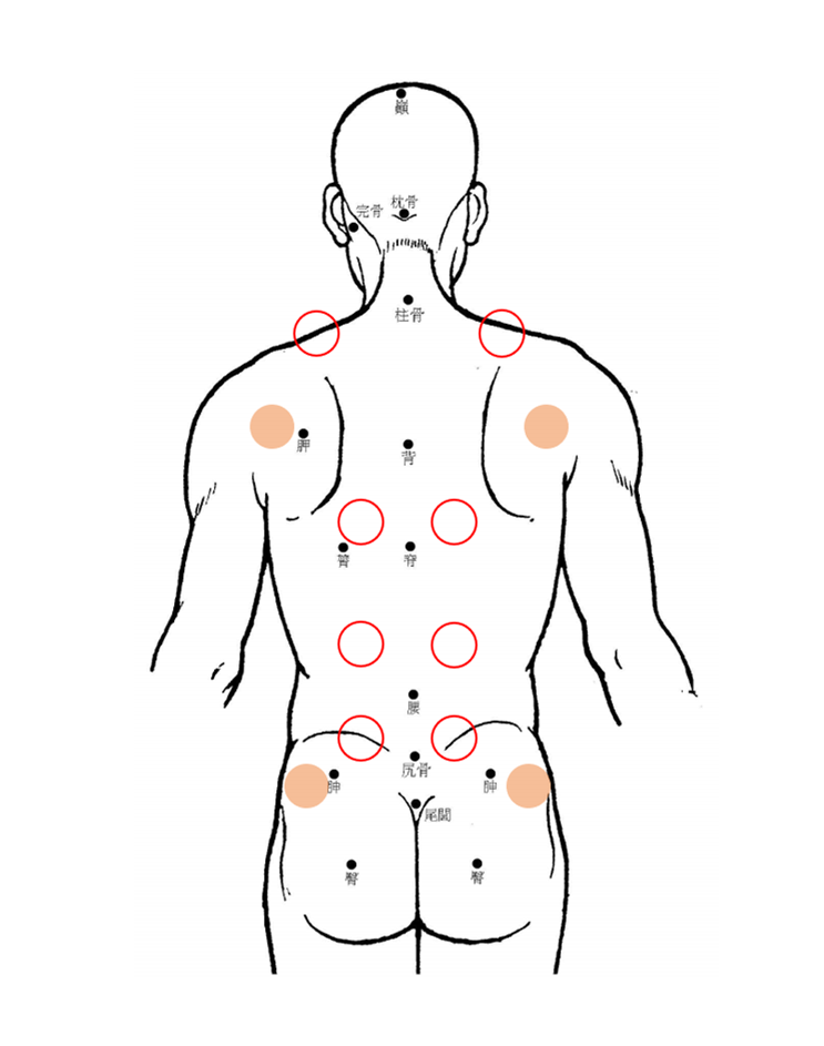부항 위치 예시 &ndash; 어깨와 등의 추천 지점