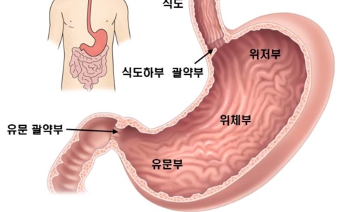 위암 이미지