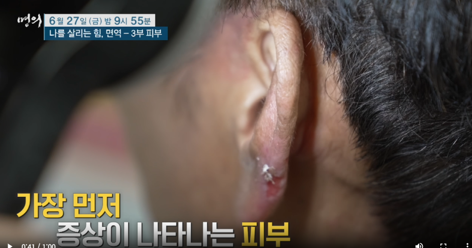 명의 나를살리는 힘 면역 3부 피부