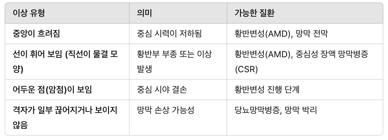 이상 시야 패턴 &amp; 황반변성 증상