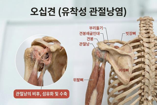 오십견 원인 어깨통증 노화