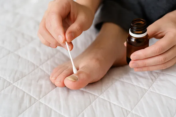 무좀 재발 막는 생활 습관