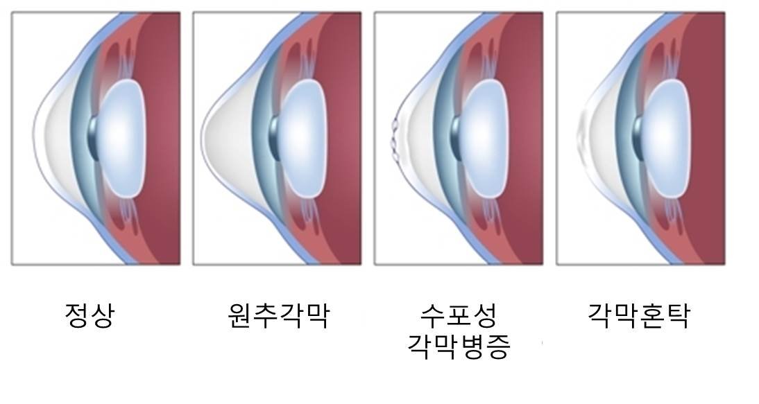 각막혼탁
