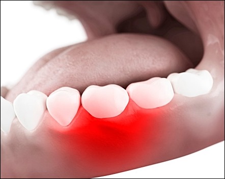 잇몸이 붓는 이유 10